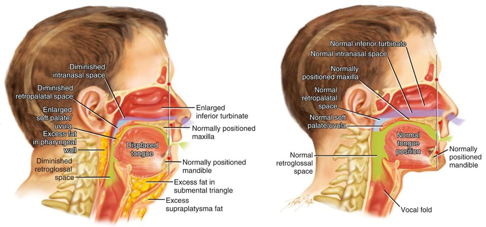 Airway anatomy before and after OSA treatment
